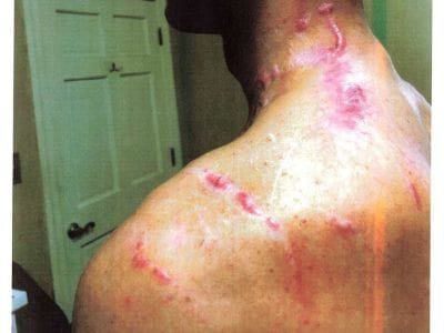 Broken leg and severe upper-body scarring stemming from motor vehicle collision.