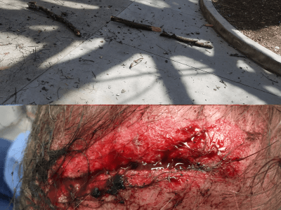 laceration from fallen tree limb