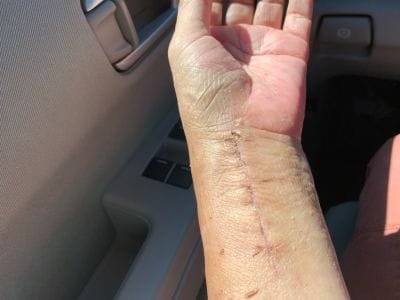 scarred arm after dog attack