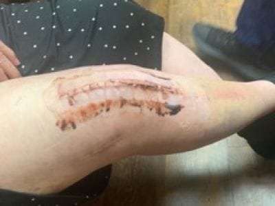 client has scars after slip and fall accident