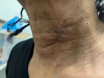 scar from neck injury