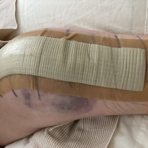 client with injured leg